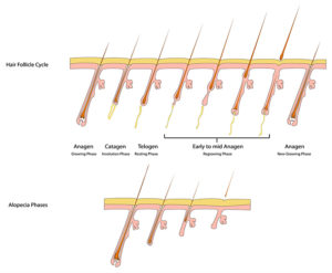 Alopecia Stages