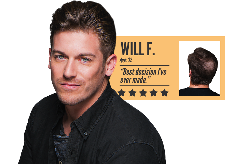 Men's Hair Loss Before & After - HPIHair Partners