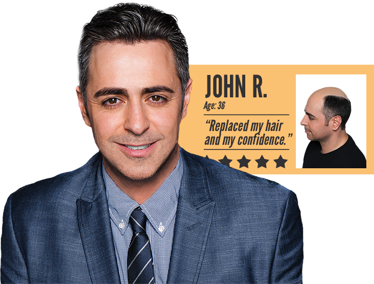 Men's Hair Loss Before & After - HPIHair Partners