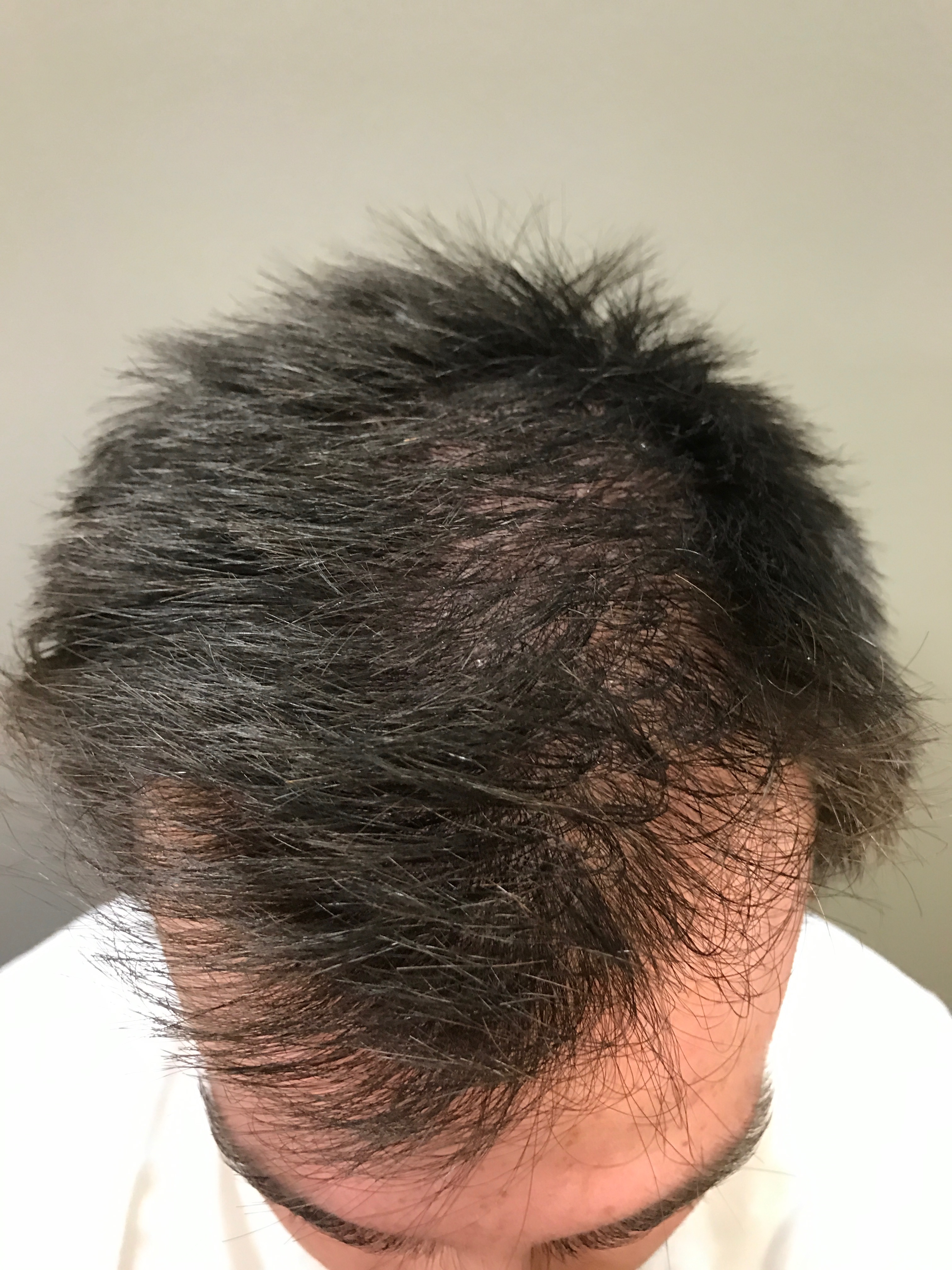 George, prior to treatment and PRP