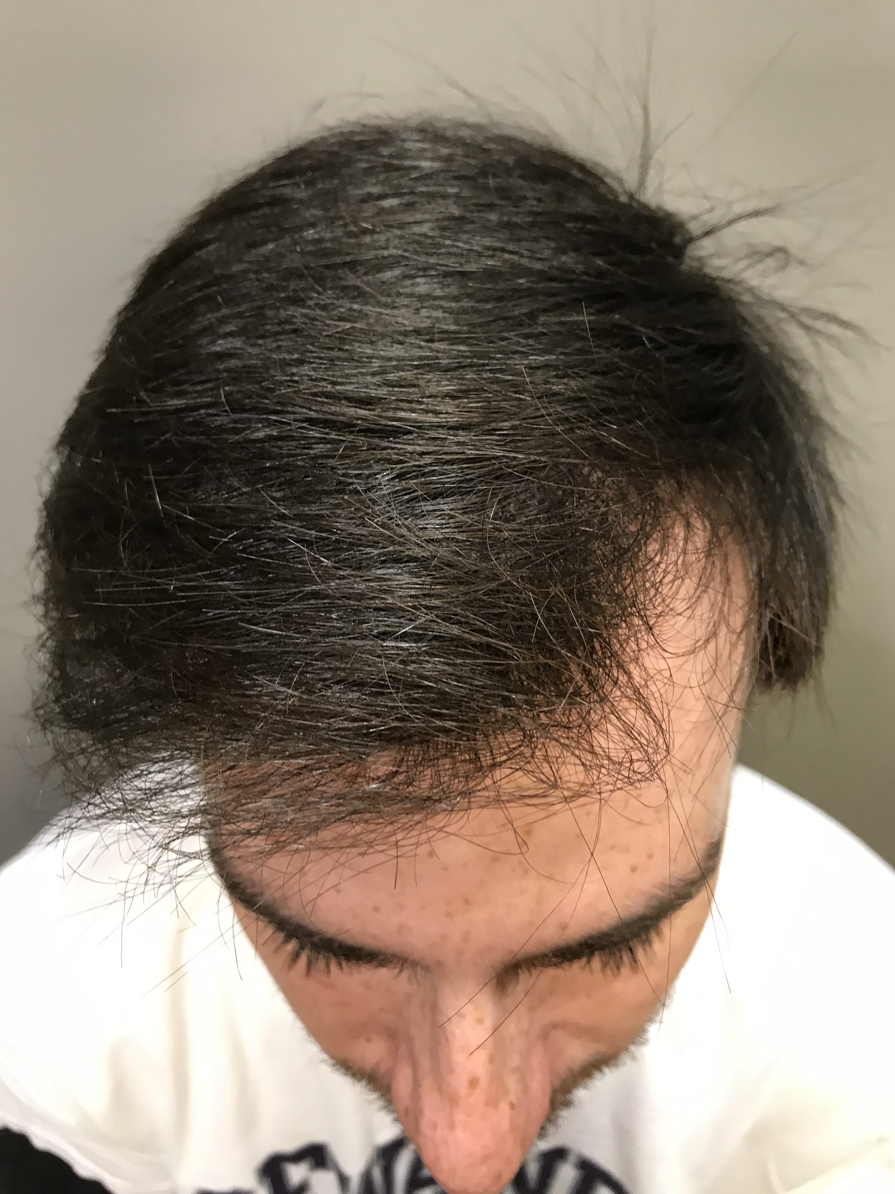 George, post treatments and PRP