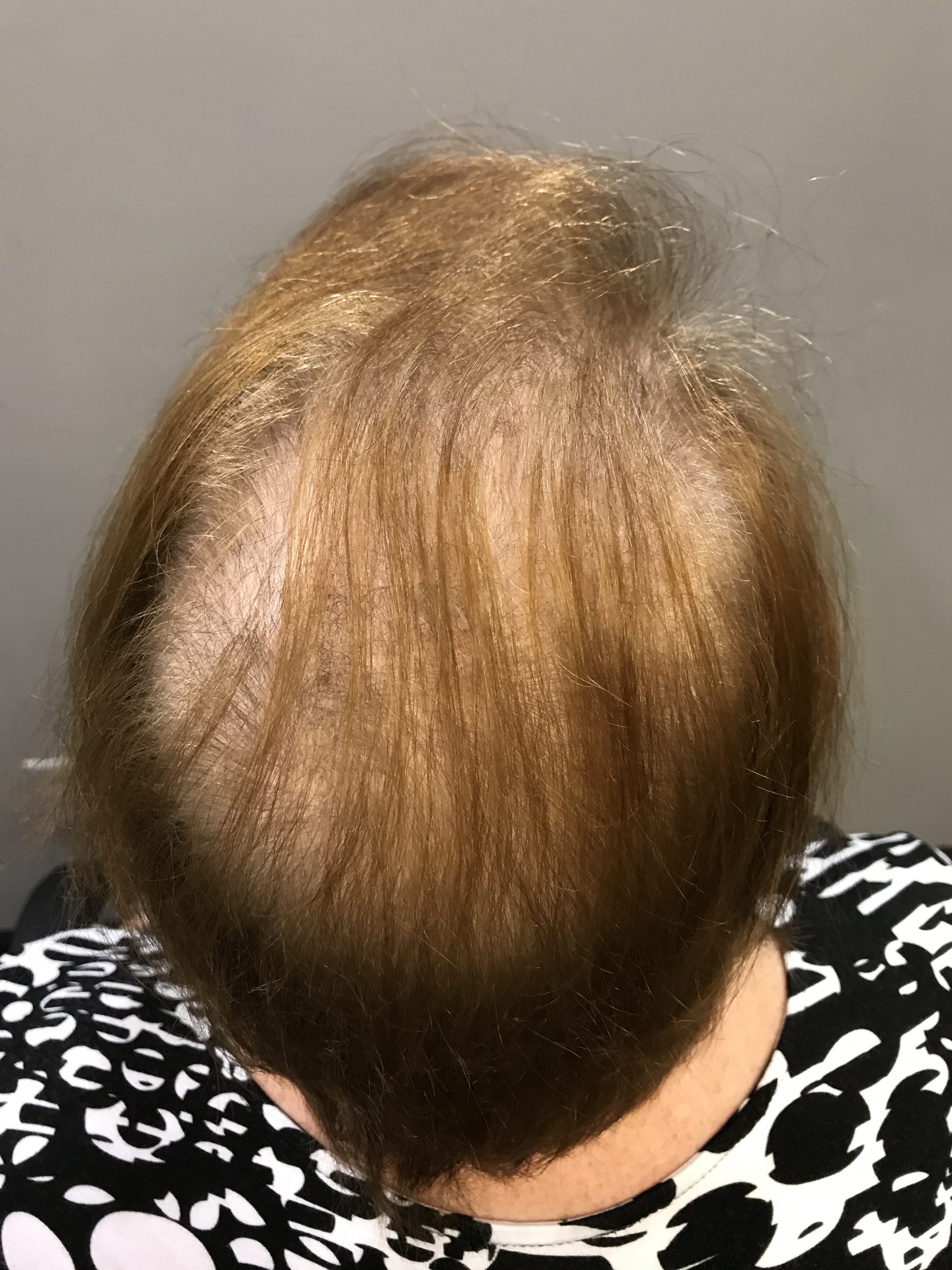 Linda, after treatment and PRP