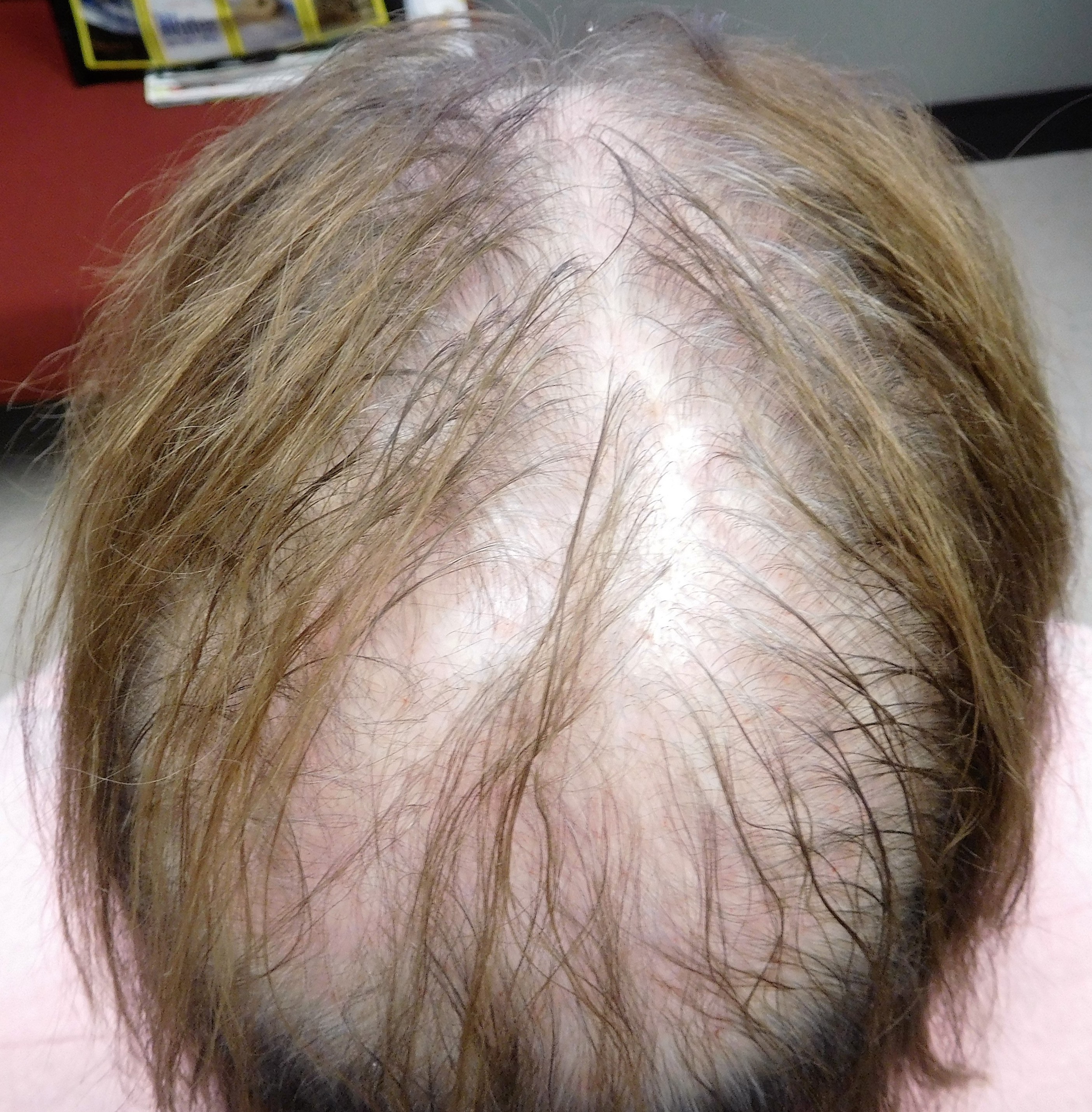 Linda, Pre treatment and PRP