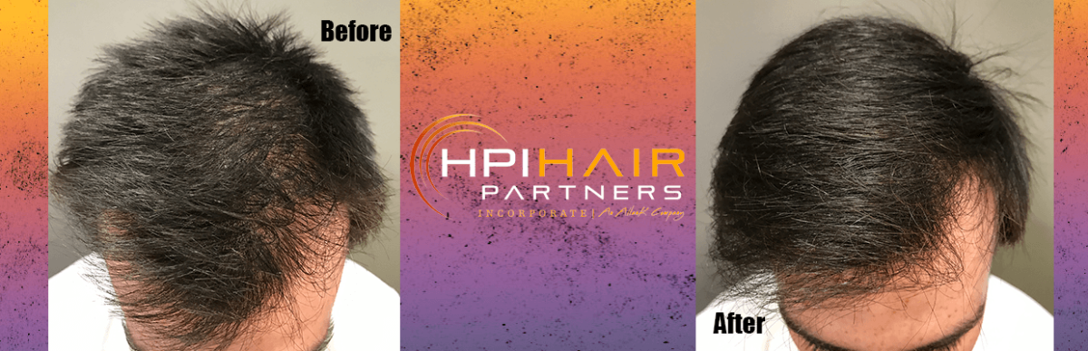 Prp Platelet Rich Plasma Archives Hpi Hair Partners Nashville