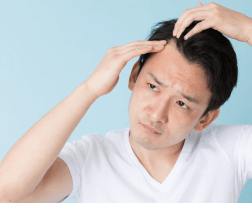 Alopecia: Genes, Hormones, and More Causes of Hair Loss