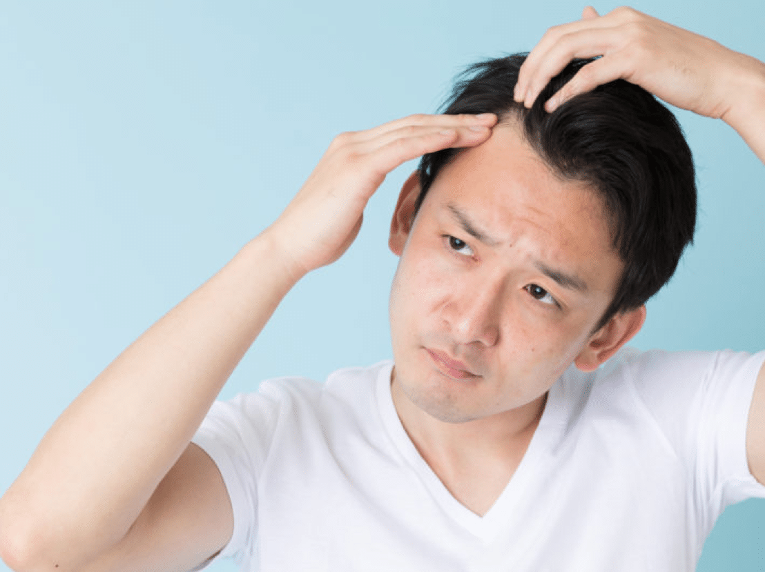 Alopecia: Genes, Hormones, and More Causes of Hair Loss