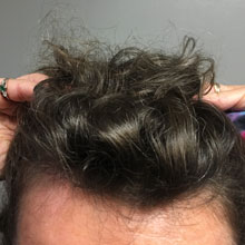 21 week post treatments and PRP