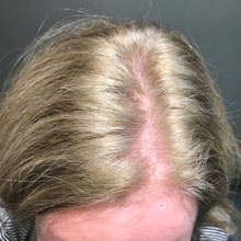 Before, Pre treatment and PRP
