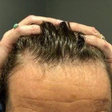 Before treatment and PRP
