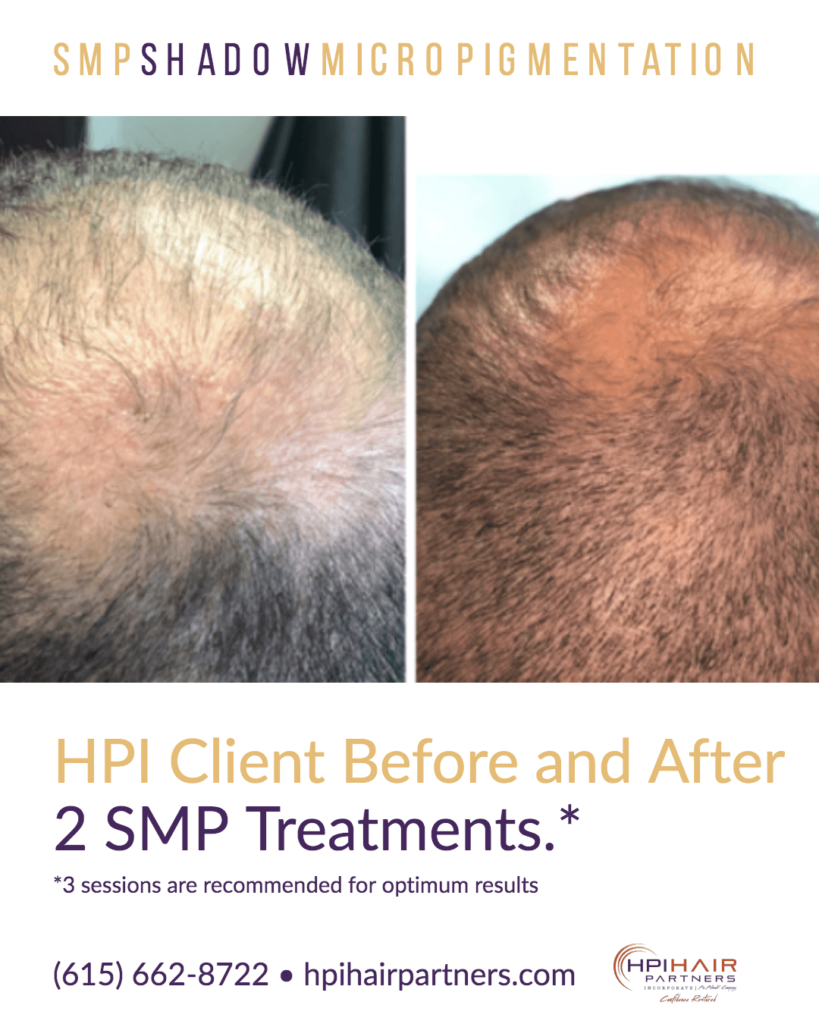 Scalp Micro-pigmentation [SMP] Client Success Story| HPIHair Partners