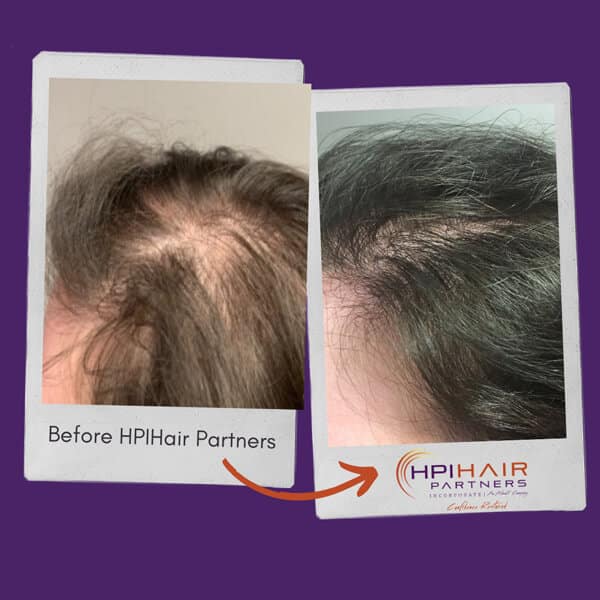 A woman's hair before and after a hair transplant, addressing hormone imbalances.