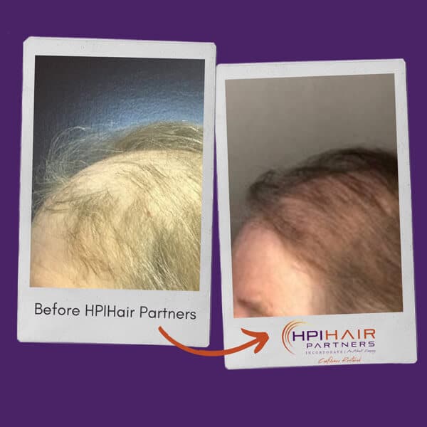 Before & After HPIHair Partners