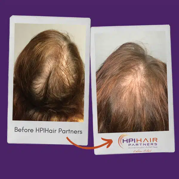 A before and after photo of a patient with telogen effluvium-induced hair loss.