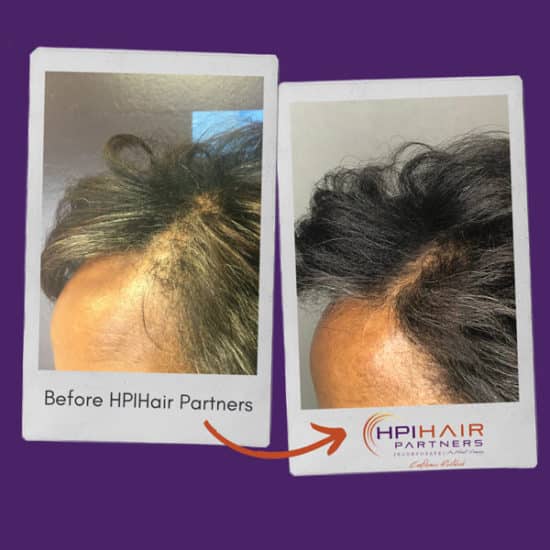 Hair Loss Treatments Hpihair Partners