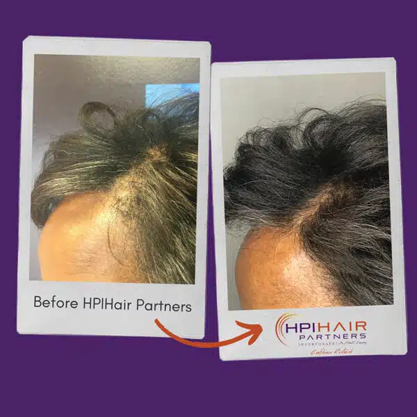 Before and after hyaluronic acid treatment for hair loss caused by hormone imbalances or thyroid issues.