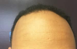 A man's hair before and after a hair transplant treatment for telogen effluvium.
