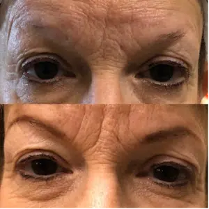 A woman's eyebrows before and after brow and eye enhancement treatment.