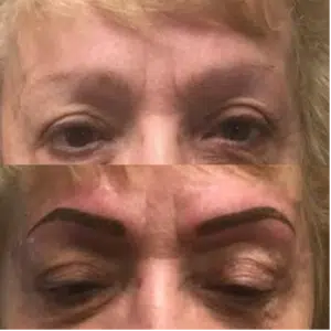 Before and after pictures showcasing brow enhancement.
