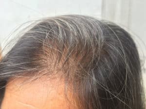 A woman's head with gray hair experiencing telogen effluvium.