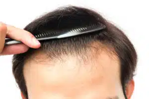 A man with thinning hair is combing his hair with a comb.