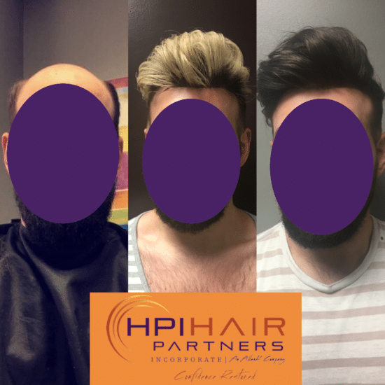 Hair Replacement Examples
