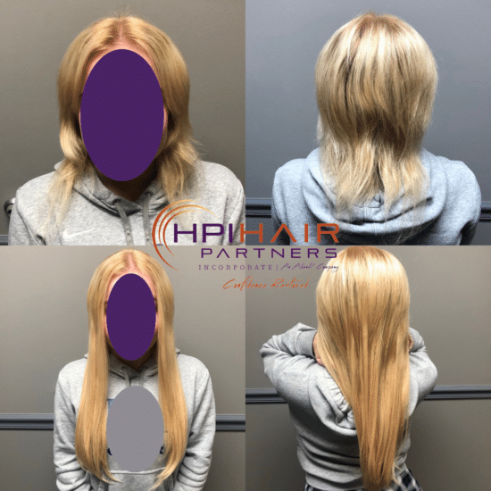 Hair Replacement For Women