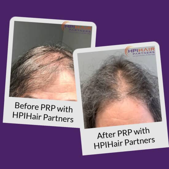 Before & After PRP with HPIHair Partners