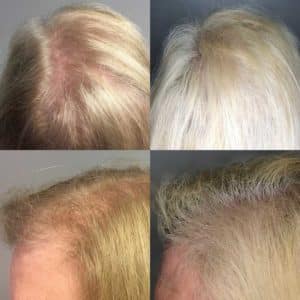 A woman's hair before and after a microneedling hair transplant.