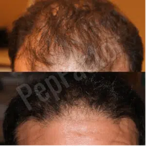 A man's hair before and after undergoing a hair transplant procedure.