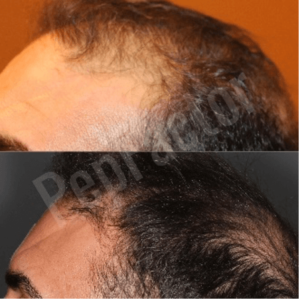 A man's hair transformation after a hair transplant.