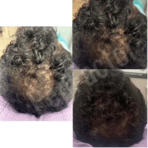 A person's hair before and after a microneedling hair transplant.