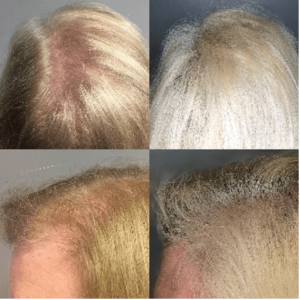 A woman's hair after undergoing a transformative hair transplant procedure.