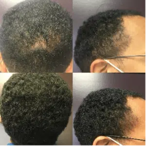 A man's hair before and after a microneedling hair transplant.
