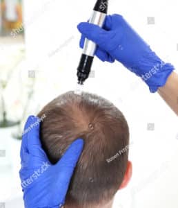 A man is undergoing microneedling during a hair transplant stock photo.
