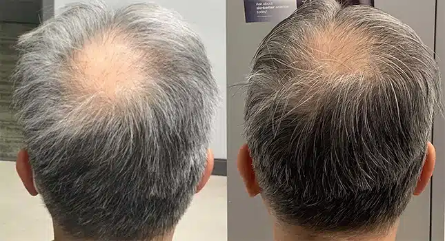 A man's hair loss transformed after undergoing microneedling treatment.