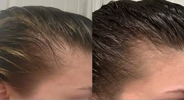 A woman's hair undergoes a remarkable transformation after a microneedling hair treatment.