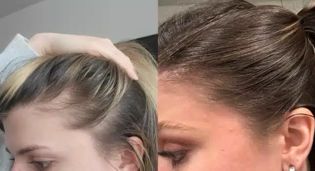 Before and after pictures of a woman's hair after microneedling treatment.