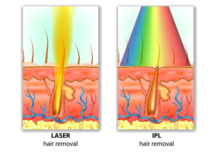 Laser & IPL Hair Removal