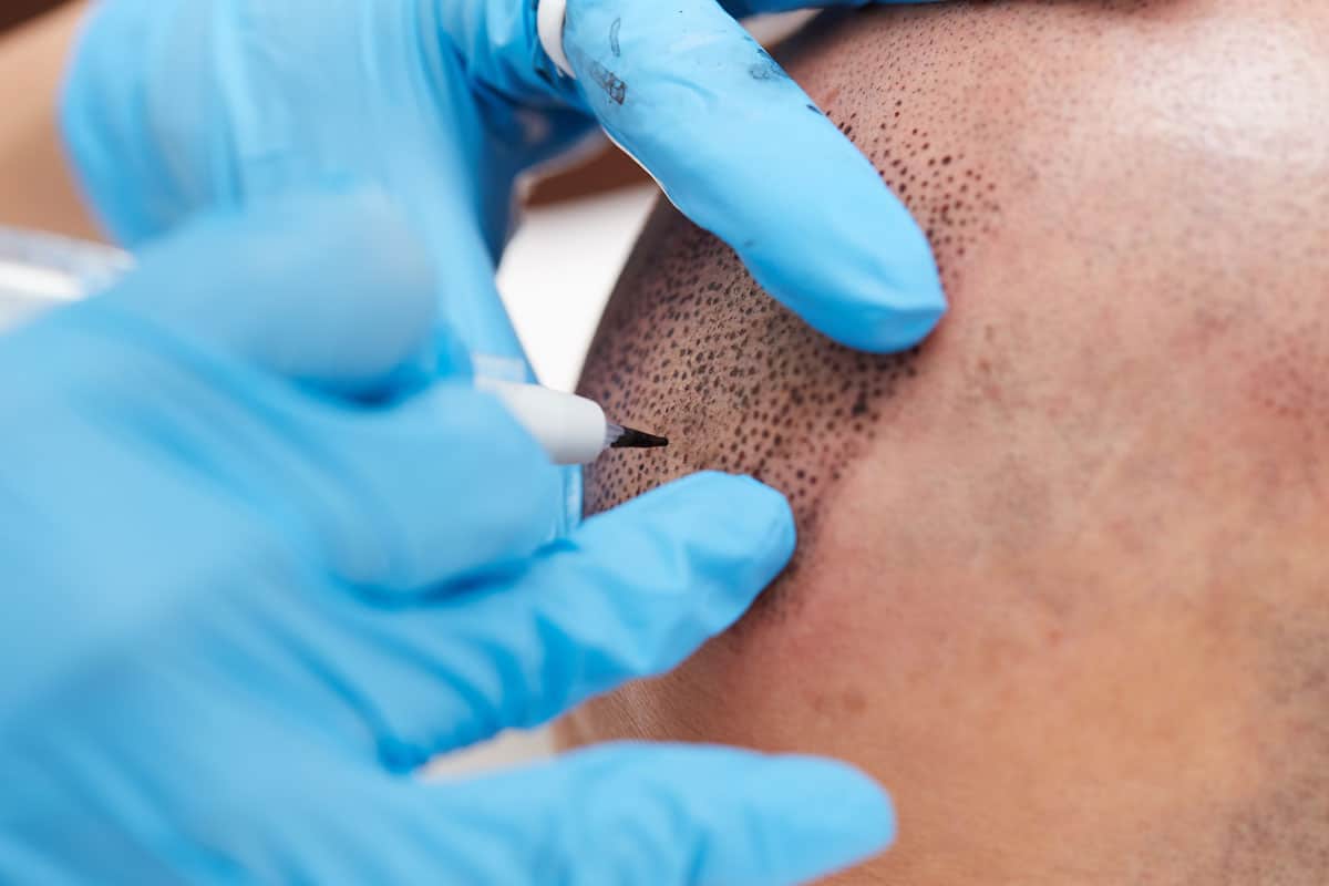 A man is undergoing scalp micropigmentation, receiving a tattoo on his head.