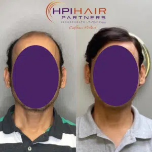 A man experiencing hair loss undergoes a transformative before and after a hair transplant.