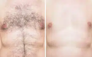 Laser Hair Removal Example Scaled