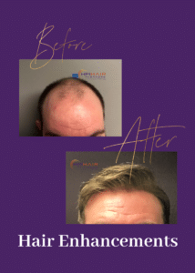 Before and after hair replacement for men.