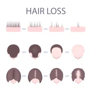 Hair Loss Diagram