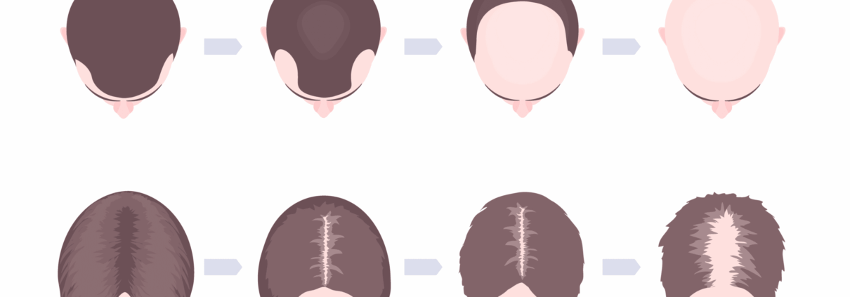 Hair Loss Progression Edited