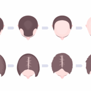 Hair Loss Progression Edited