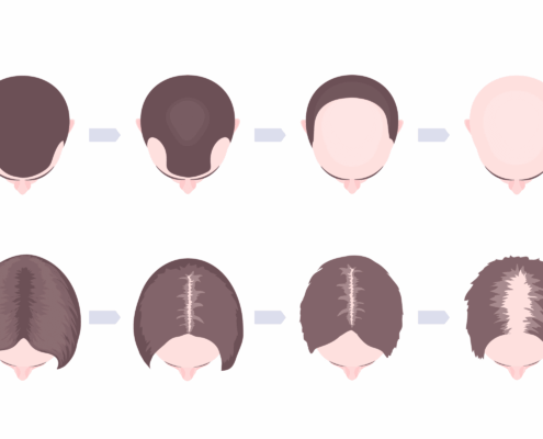 Hair Loss Progression Edited