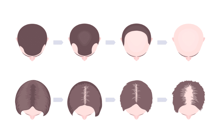 Hair Loss Progression Edited