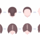 Hair Loss Progression Edited