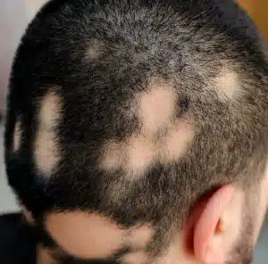 A man with patches of bald spots on his head due to Alopecia Areata.