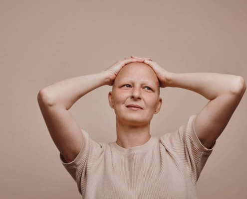 Women with Alopecia Totalis